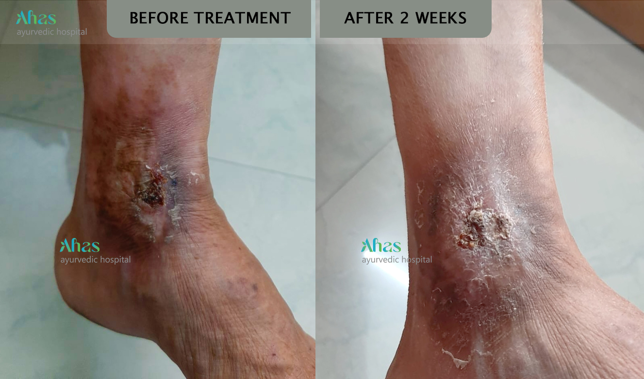 Varicose Vein bleeding and edema- Treatment result